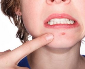 Ăn bánh trung thu có nổi mụn không? Có ảnh hưởng sức khỏe?