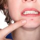 Ăn bánh trung thu có nổi mụn không? Có ảnh hưởng sức khỏe?